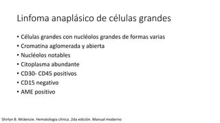 Linfoma anaplásico de células grandes
• Células grandes con nucléolos grandes de formas varias
• Cromatina aglomerada y abierta
• Nucléolos notables
• Citoplasma abundante
• CD30- CD45 positivos
• CD15 negativo
• AME positivo
Shirlyn B. Mckenzie. Hematologia clínica. 2da edición. Manual moderno
 