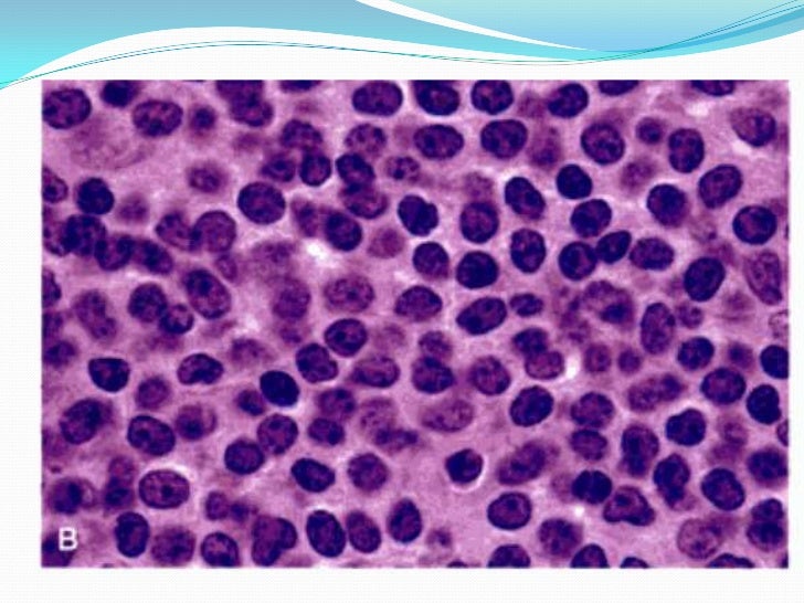 Linfoma no hodgkin