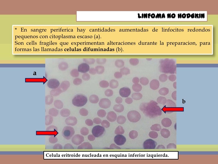 Linfoma no hodgkin