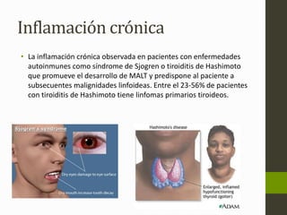Inflamación crónica 
• La inflamación crónica observada en pacientes con enfermedades 
autoinmunes como síndrome de Sjogren o tiroiditis de Hashimoto 
que promueve el desarrollo de MALT y predispone al paciente a 
subsecuentes malignidades linfoideas. Entre el 23-56% de pacientes 
con tiroiditis de Hashimoto tiene linfomas primarios tiroideos. 
 