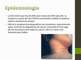 • La ACS estima que hay 65,540 casos nuevos de LNH cada año. La 
incidencia a partir del año 1970 ha aumentado el doble sin poderse 
explicar exactamente porque. 
• LNH es la neoplasia hematopoyética mas prevalente, representando 
aprox. el 4% de los diagnósticos de cáncer y teniendo el 7mo lugar 
de mas frecuente entre todos los cáncer. LNH es 5 veces mas 
frecuente que Hodkin. 
 