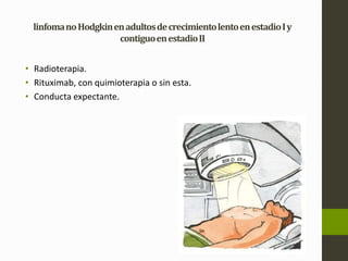 linfoma no Hodgkin en adultos de crecimiento lento en estadio I y 
contiguo en estadio II 
• Radioterapia. 
• Rituximab, con quimioterapia o sin esta. 
• Conducta expectante. 
 