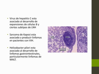 • Virus de hepatitis C esta 
asociado al desarrollo de 
expansiones de células B y 
ciertos subtipos de LNH 
• Sarcoma de Kaposi esta 
asociado a producir linfomas 
en pacientes con VIH. 
• Helicobacter pilori esta 
asociado al desarrollo de 
linfomas gastrointestinales, 
particularmente linfomas de 
MALT. 
 