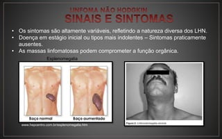 • Os sintomas são altamente variáveis, refletindo a natureza diversa dos LHN.
• Doença em estágio inicial ou tipos mais indolentes – Sintomas praticamente
ausentes.
• As massas linfomatosas podem comprometer a função orgânica.
Esplenomegalia
www.hepcentro.com.br/esplenomegalia.htm
 