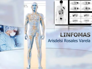 LINFOMAS Arisdelsi Rosales Varela 