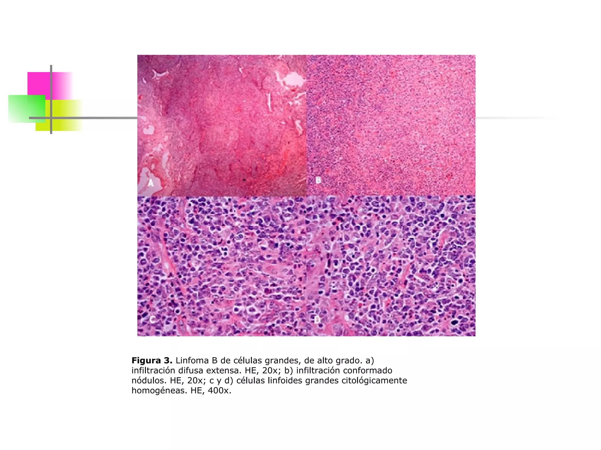                                                                      Figura 3.  Linfoma B de células grandes, de alto grado. a) infiltración difusa extensa. HE, 20x; b) infiltración conformado nódulos. HE, 20x; c y d) células linfoides grandes citológicamente homogéneas. HE, 400x.  
