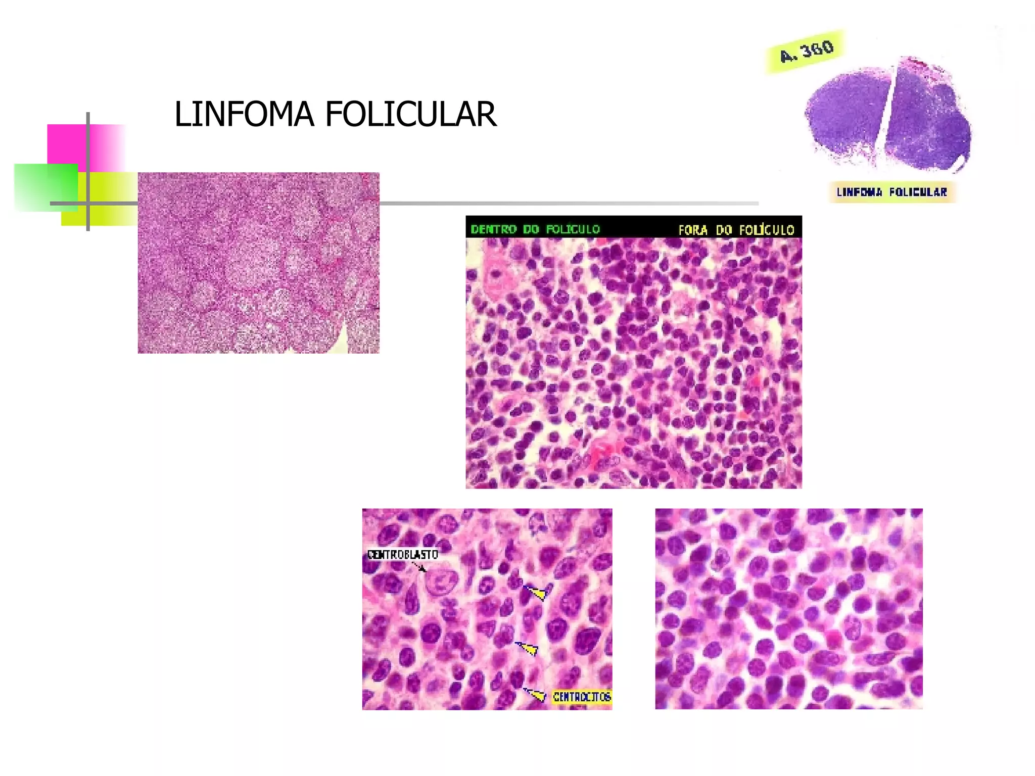 LINFOMA FOLICULAR 
