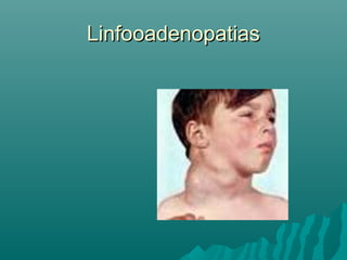 Linfooadenopatias

 