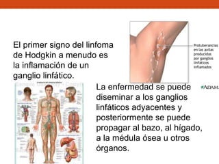 El primer signo del linfoma
de Hodgkin a menudo es
la inflamación de un
ganglio linfático.
La enfermedad se puede
diseminar a los ganglios
linfáticos adyacentes y
posteriormente se puede
propagar al bazo, al hígado,
a la médula ósea u otros
órganos.

 