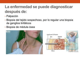 La enfermedad se puede diagnosticar
después de:
• Palpación
• Biopsia del tejido sospechoso, por lo regular una biopsia

de ganglios linfáticos
• Biopsia de médula ósea

 