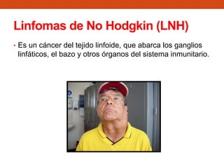 Linfomas de No Hodgkin (LNH)
• Es un cáncer del tejido linfoide, que abarca los ganglios

linfáticos, el bazo y otros órganos del sistema inmunitario.

 