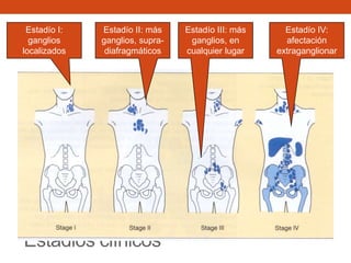 Estadío I:
ganglios
localizados

Estadío II: más
ganglios, supradiafragmáticos

Estadios clínicos

Estadío III: más
ganglios, en
cualquier lugar

Estadío IV:
afectación
extraganglionar

 