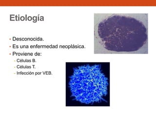 Etiología
• Desconocida.
• Es una enfermedad neoplásica.
• Proviene de:
- Células B.
- Células T.
- Infección por VEB.

 