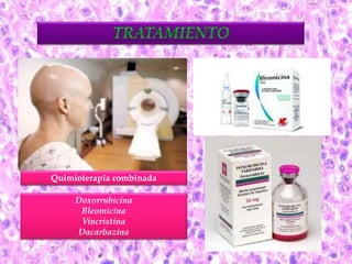 Quimioterapia combinada 
Doxorrubicina 
Bleomicina 
Vincristina 
Dacarbazina 
 