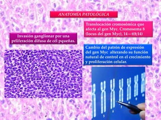 ANATOMÍA PATOLÓGICA 
Invasión ganglionar por una 
prliferación difusa de cél pqueñas. 
Translocación cromosómica que 
afecta al gen Myc. Cromosoma 8 
(locus del gen Myc), 14—t(8;14) 
Cambio del patrón de expresión 
del gen Myc alterando su función 
natural de control en el crecimiento 
y proliferación celular. 
 