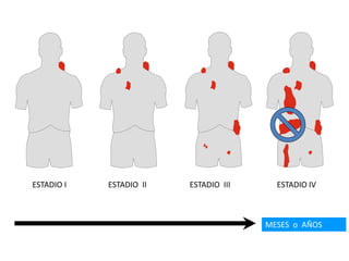 MESES o AÑOS
ESTADIO I ESTADIO II ESTADIO III ESTADIO IV
 