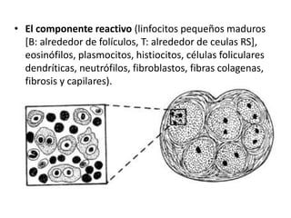 • El componente reactivo (linfocitos pequeños maduros
[B: alrededor de folículos, T: alrededor de ceulas RS],
eosinófilos, plasmocitos, histiocitos, células foliculares
dendríticas, neutrófilos, fibroblastos, fibras colagenas,
fibrosis y capilares).
 
