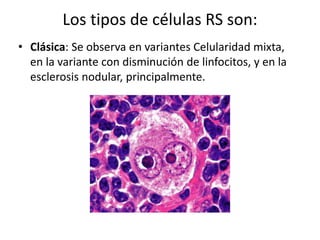 Los tipos de células RS son:
• Clásica: Se observa en variantes Celularidad mixta,
en la variante con disminución de linfocitos, y en la
esclerosis nodular, principalmente.
 