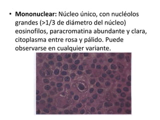 • Mononuclear: Núcleo único, con nucléolos
grandes (>1/3 de diámetro del núcleo)
eosinofilos, paracromatina abundante y clara,
citoplasma entre rosa y pálido. Puede
observarse en cualquier variante.
 