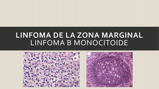 LINFOMA DE LA ZONA MARGINAL
LINFOMA B MONOCITOIDE

 