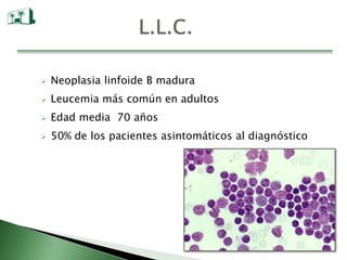    Neoplasia linfoide B madura
   Leucemia más común en adultos
   Edad media 70 años
   50% de los pacientes asintomáticos al diagnóstico
 