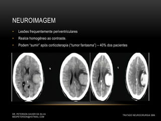 NEUROIMAGEM
DR. PETERSON XAVIER DA SILVA
MEDPETERSON@HOTMAIL.COM
• Lesões frequentemente periventriculares
• Realce homogêneo ao contraste.
• Podem “sumir” após corticoterapia (“tumor fantasma”) – 40% dos pacientes
TRATADO NEUROCIRURGIA SBN
 