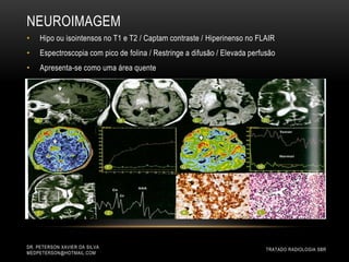 NEUROIMAGEM
DR. PETERSON XAVIER DA SILVA
MEDPETERSON@HOTMAIL.COM
• Hipo ou isointensos no T1 e T2 / Captam contraste / Hiperinenso no FLAIR
• Espectroscopia com pico de folina / Restringe a difusão / Elevada perfusão
• Apresenta-se como uma área quente
TRATADO RADIOLOGIA SBR
 