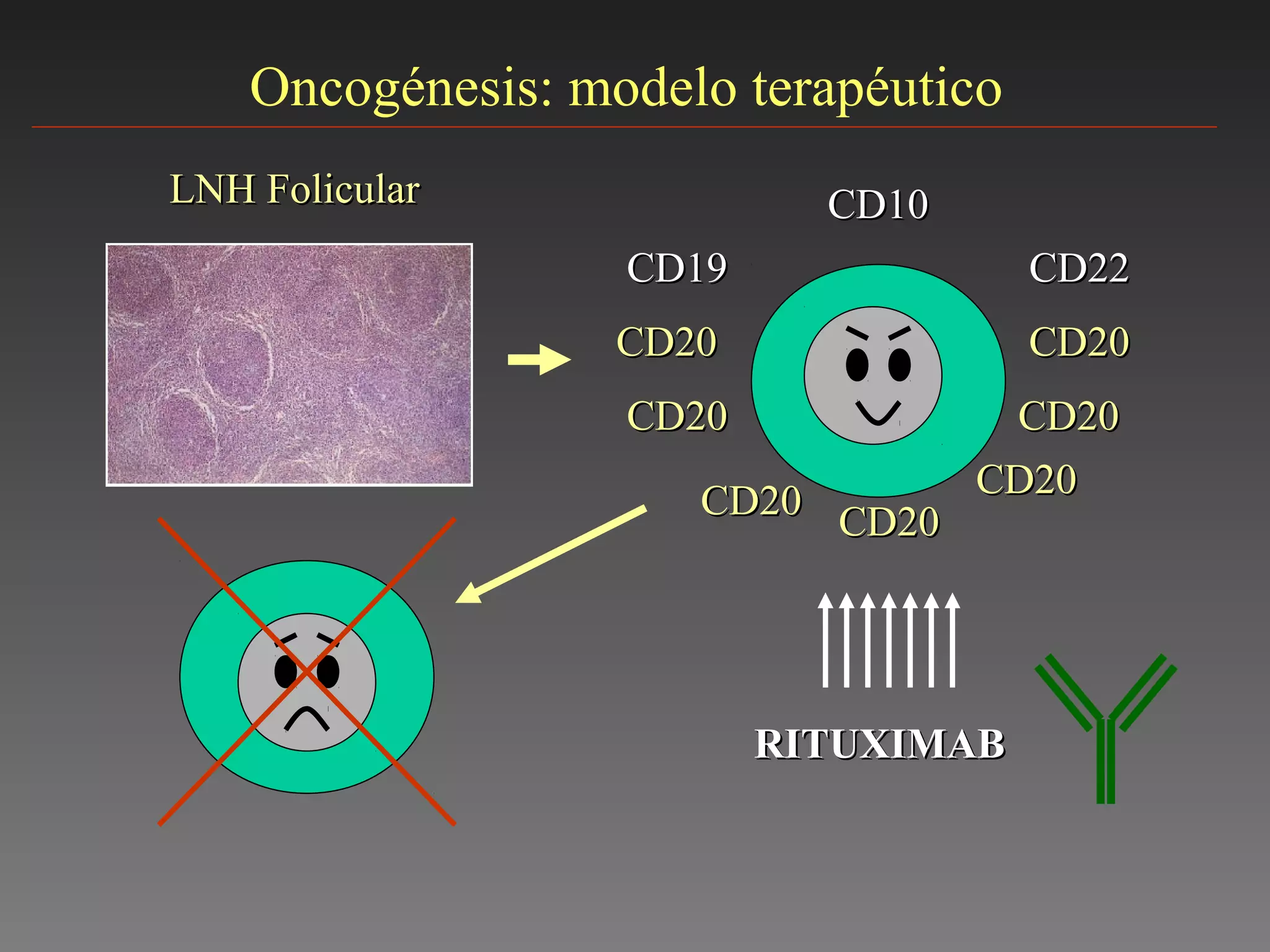 Oncogénesis: modelo terapéutico
LNH FolicularLNH Folicular CD10CD10
CD19CD19 CD22CD22
CD20CD20CD20CD20
CD20CD20
CD20CD20
CD20CD20
CD20CD20
CD20CD20
RITUXIMABRITUXIMAB
 