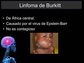 • De África central.
• Causado por el virus de Epstein-Barr
• No es contagioso
Linfoma de Burkitt
 