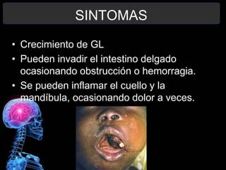 SINTOMAS
• Crecimiento de GL
• Pueden invadir el intestino delgado
ocasionando obstrucción o hemorragia.
• Se pueden inflamar el cuello y la
mandíbula, ocasionando dolor a veces.
 