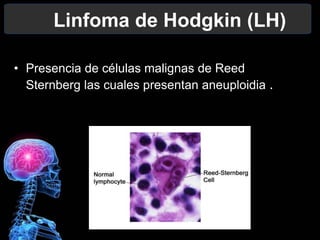 Linfoma de Hodgkin (LH)
• Presencia de células malignas de Reed
Sternberg las cuales presentan aneuploidia .
 