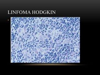 LINFOMA HODGKIN
• Classificação OMS:
• LH clássico:
• Esclerose nodular (65%);
• Celularidade mista (25%);
• Rico em linfócitos (5%);
• Depleção linfocítica.
• LH com predomínio linfocítico (CD20+).

 