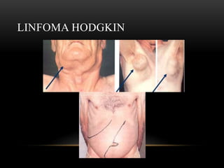 LINFOMA HODGKIN

 