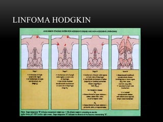 LINFOMA HODGKIN

 