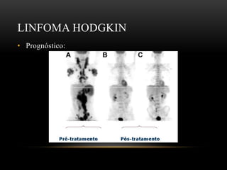 LINFOMA HODGKIN
• Prognóstico:

 