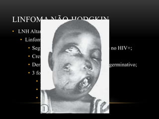 LINFOMA NÃO-HODGKIN
• LNH Altamente agressivos:
• Linfoma de Burkitt:
• Segundo mais comum na infância e no HIV+;
• Crescimento tumoral muito rápido;

• Derivado de linfócitos B do centro germinativo;
• 3 formas:
• Esporádica (EUA/Europa);

• Endêmica africana;
• HIV +.

 