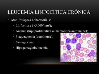 LEUCEMIA LINFOCÍTICA CRÔNICA
• Manifestações Laboratoriais:
• Linfocitose (>5.000/mm³);
• Anemia (hipoproliferativa ou hemolítica autoimune);
• Plaquetopenia (autoimune);
• Smudge cells;
• Hipogamaglobulinemia.

 