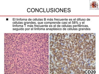 CONCLUSIONES
El linfoma de células B más frecuente es el difuso de
células grandes, que comprende casi el 58% y el
linfoma T más frecuente es el de células periféricas,
seguido por el linfoma anaplásico de células grandes




                                                CD20
 