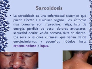 Sarcoidosis
• La sarcoidosis es una enfermedad sistémica que
puede afectar a cualquier órgano. Los síntomas
más comunes son imprecisos: fatiga, falta de
energía, pérdida de peso, dolores articulares,
sequedad ocular, visión borrosa, falta de aliento,
tos seca o lesiones cutáneas, que varían desde
enrojecimientos y pequeños nódulos hasta
eritema nodoso o lupus.
 