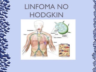 LINFOMA NO
HODGKIN
 