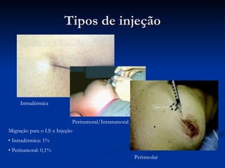 Tipos de injeção Migração para o LS x Injeção Intradérmica: 1% Peritumoral: 0,1% Intradérmica Peritumoral/Intratumoral Periareolar 