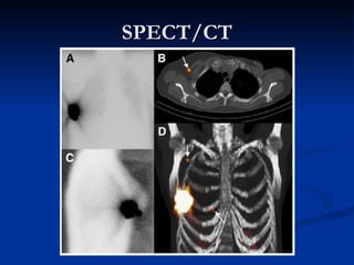SPECT/CT 