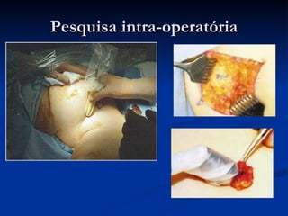 Pesquisa intra-operatória 