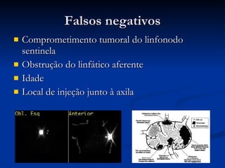 Falsos negativos Comprometimento tumoral do linfonodo sentinela Obstrução do linfático aferente Idade  Local de injeção junto à axila 