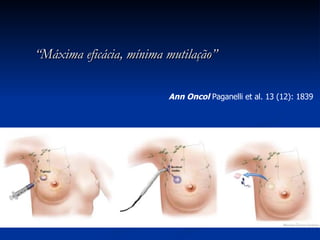 “ Máxima eficácia, mínima mutilação” Ann Oncol  Paganelli et al. 13 (12): 1839  