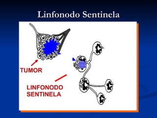 Linfonodo Sentinela TUMOR LINFONODO SENTINELA 