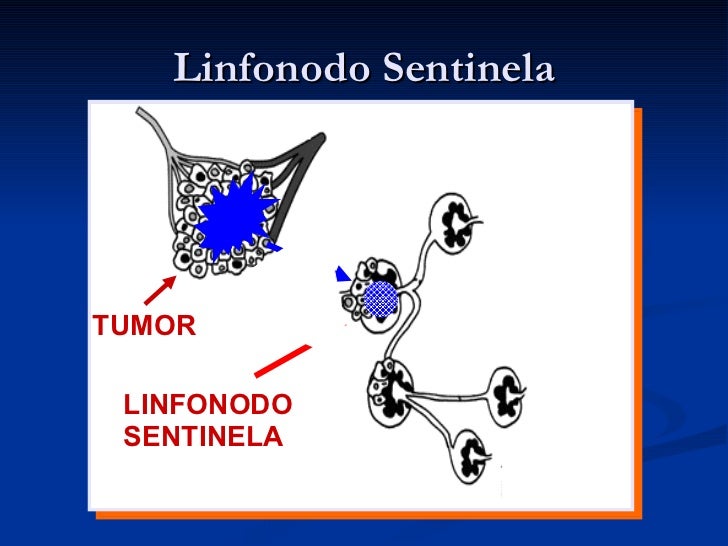 Quadrantectomia Com Linfonodos Sentinelas Quadrantectomy With