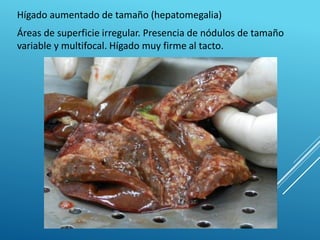 Hígado aumentado de tamaño (hepatomegalia)
Áreas de superficie irregular. Presencia de nódulos de tamaño
variable y multifocal. Hígado muy firme al tacto.
 