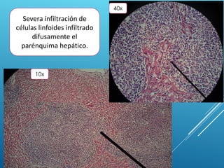 Severa infiltración de
células linfoides infiltrado
difusamente el
parénquima hepático.
10x
40x
 