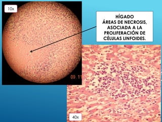 HÍGADO
ÁREAS DE NECROSIS,
ASOCIADA A LA
PROLIFERACIÓN DE
CÉLULAS LINFOIDES.
40x
10x
 
